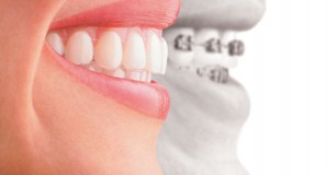 Dental Braces Mississauaga Smile Correction Mississauga
