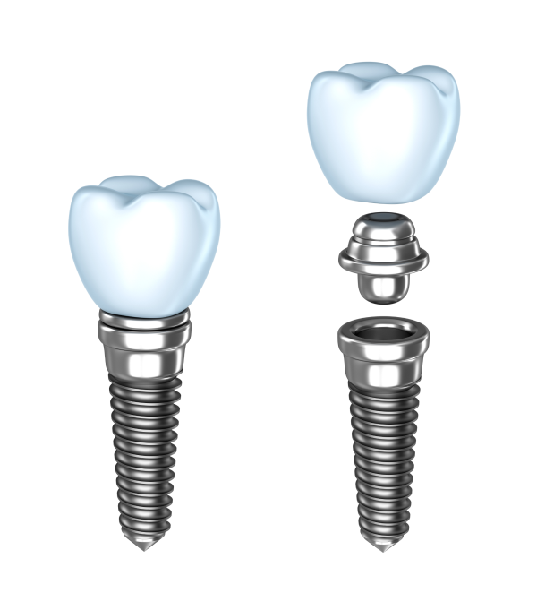 Types of Dental Implants: Endosteal, Transosteal & Subperiosteal