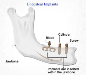endosteal-implants