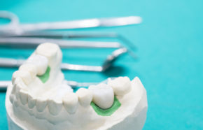 Questions and Answers About Dental Implants