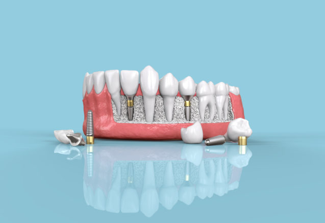 What to Expect When You Need Dental Implants